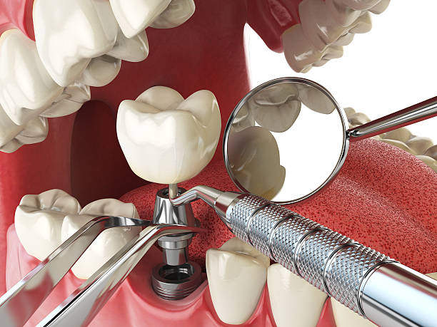 Urgent Tooth Repair in MI